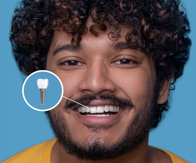 Dental-Implants