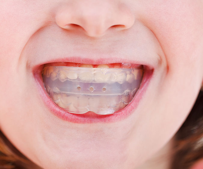 Mouthguard